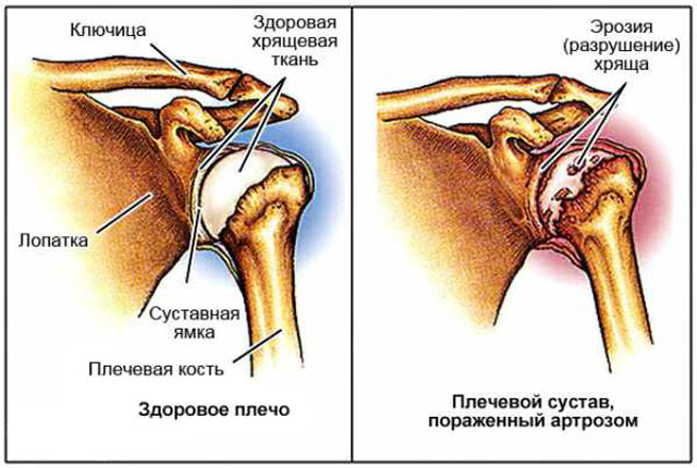 артроз плечевого сустава