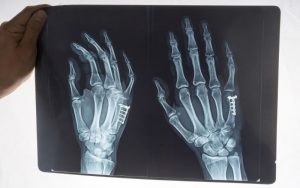 Растяжение большого пальца руки: симптомы, лечение и восстановление