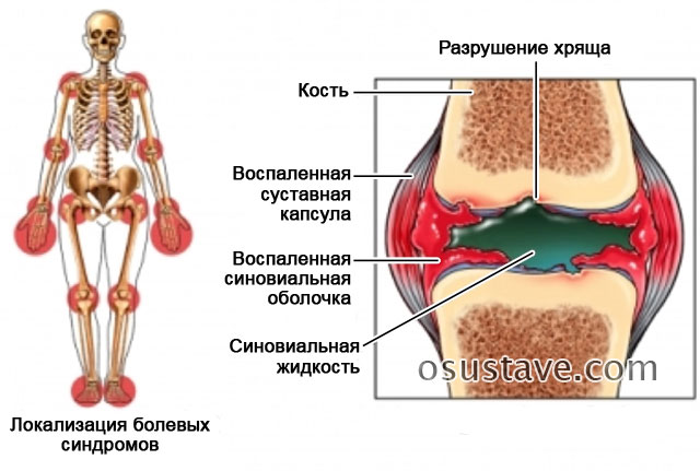 воспаление сухожилий и суставных оболочек при реактивном артрите