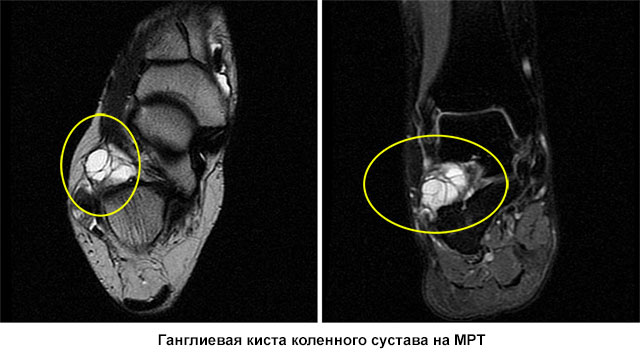ганглиевая киста коленного сустава на МРТ