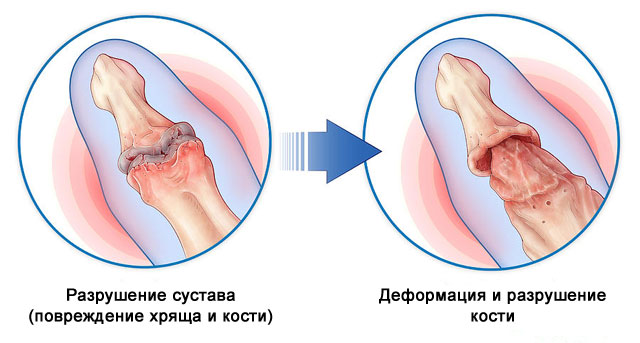 деформация суставов при псориатическом артрите