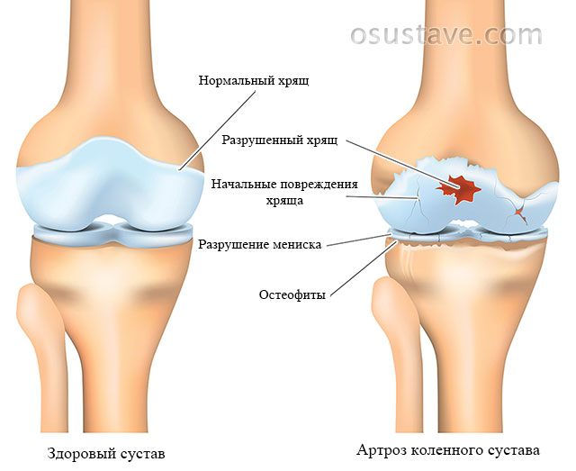 коленный сустав в норме и при артрозе