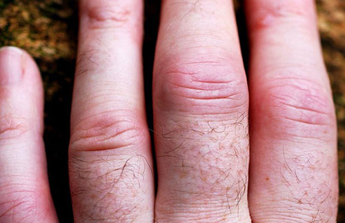 отек и воспаление пораженных артрозом суставов пальцев рук