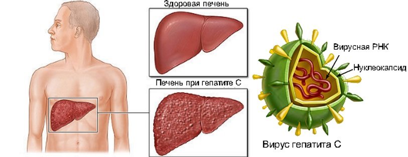 Гепатита С
