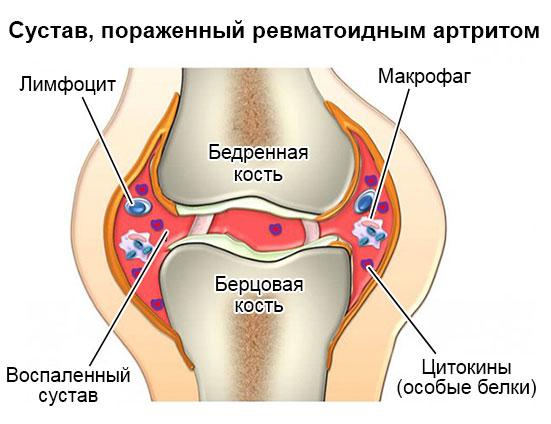 сустав, пораженный ревматоидным артритом