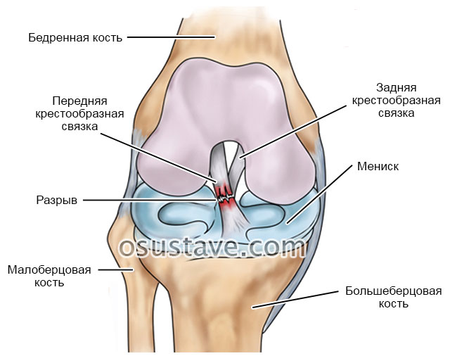 разрыв передней крестообразной связки коленного сустава