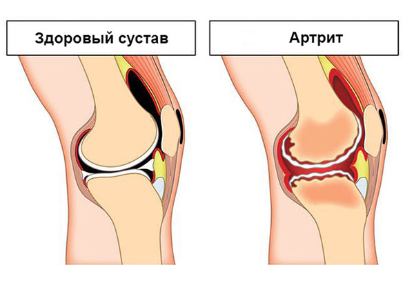 воспаления коленного сустава, приводящие к бурситу