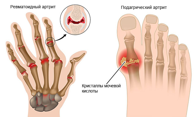 ревматоидный и подагрический артриты