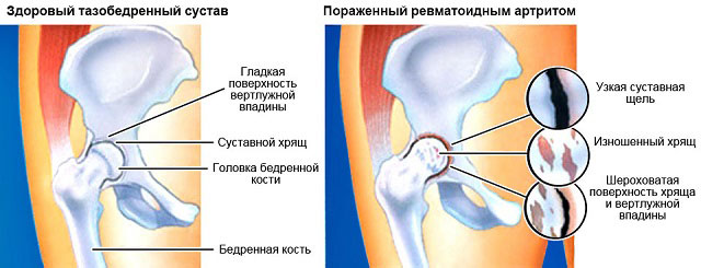 поражение тазобедренного сустава ревматоидным артритом