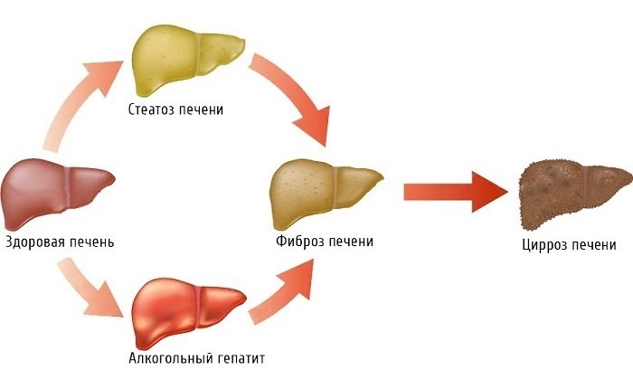 Причины развития цирроза печени