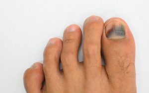 Чёрный большой палец на ноге