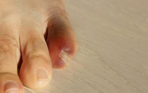 Перелом пальца на ноге. Симптомы, диагностика и лечение