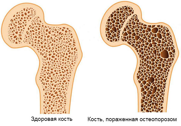 нормальная кость и пораженная остеопорозом