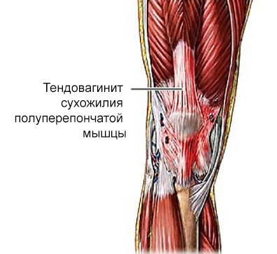 тендовагинит сухожилия полуперепончатой мышцы