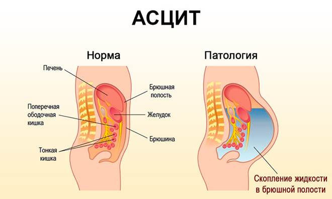 Асцит брюшной полости при циррозе