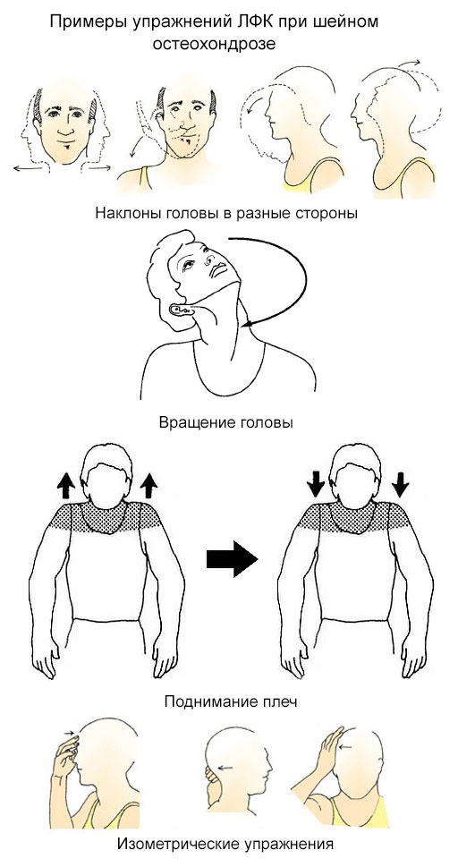 примеры упражнений ЛФК при шейном остеохондрозе
