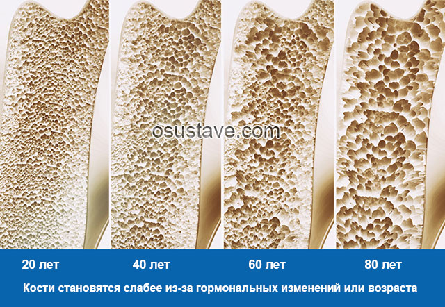 изменения костей с возрастом при остеопорозе