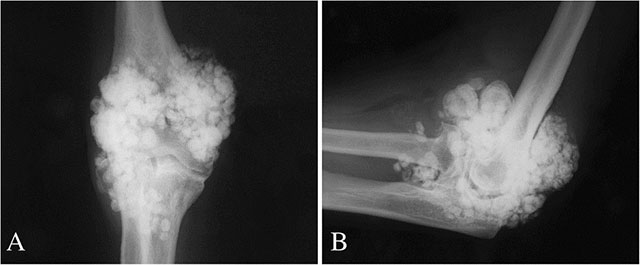 рентген снимок сустава при синовиальном хондроматозе