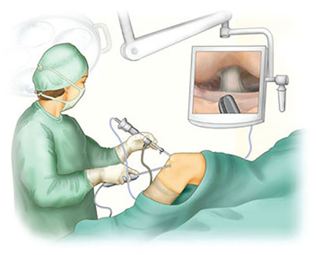 проведение артроскопии колена