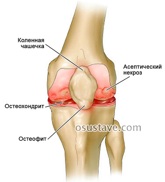 Асептический некроз мыщелка. Остеохондропатия коленного сустава Кенига. Остеохондрит коленного сустава. Болезнь Кенига коленного. Некроз коленного сустава (остеонекроз).
