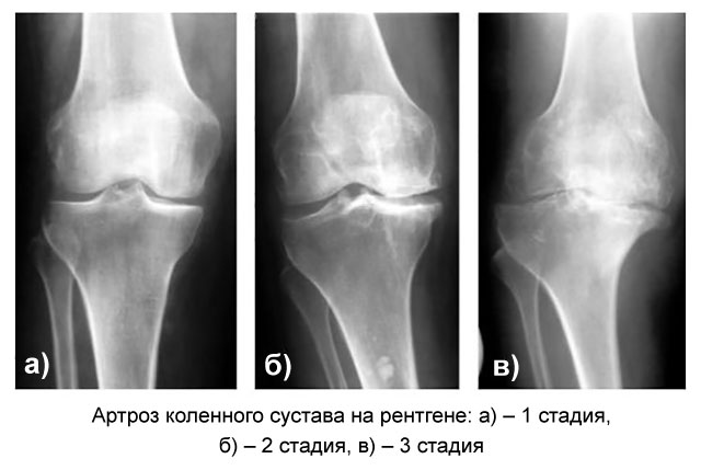 три степени артроза колена на рентгеновских снимках