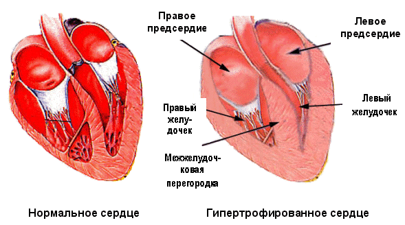 chto-takoe-gipertrofiya-miokarda-levogo-zheludochka