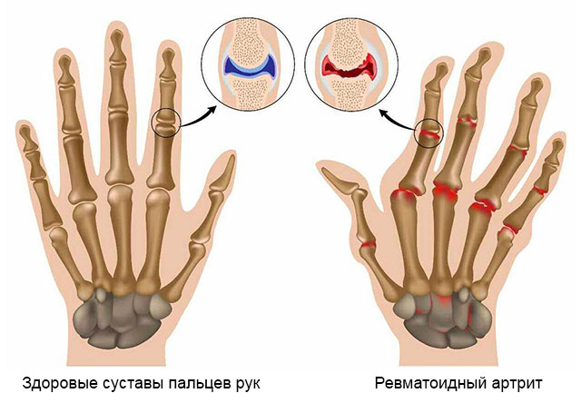 здоровые суставы пальцев рук и пораженные ревматоидным артритом