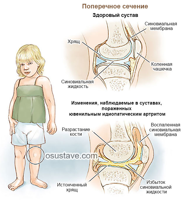 ювенильный ревматоидный артрит у ребенка
