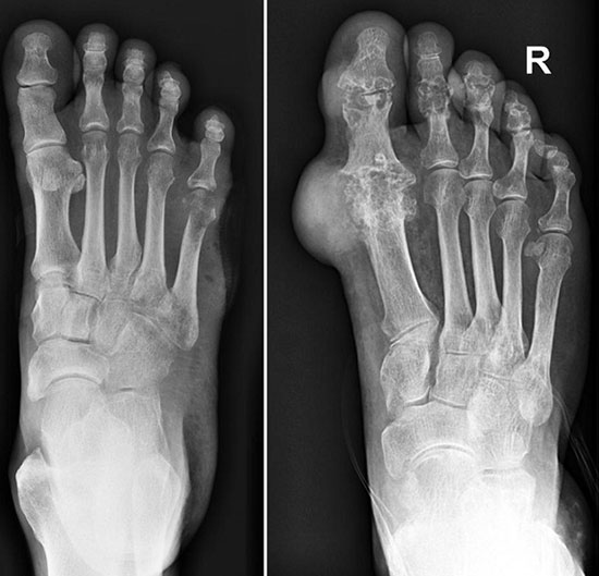 рентген здоровой ступни и пораженной подагрой