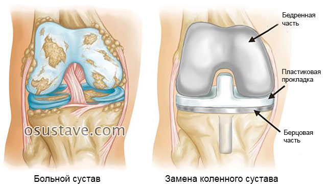 пораженный артрозом коленный сустав и эндопротезирование колена
