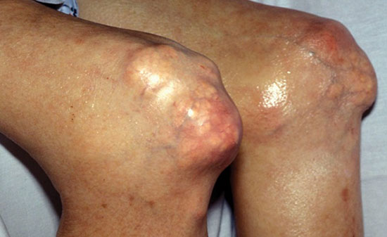 множественные тофусы в области коленных суставов у пациента с подагрой