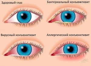 Аллергия на глазах симптомы.