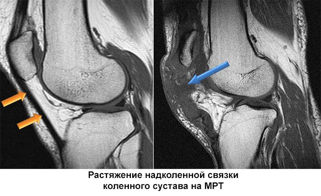 МРТ коленного сустава при растяжении связок