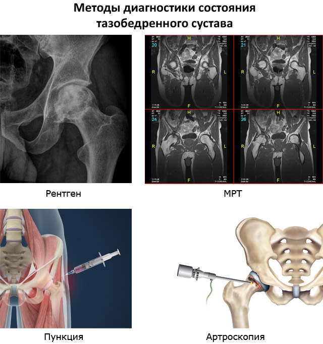 методы диагностики состояния тазобедренного сустава – рентген, МРТ, пункция, артроскопия