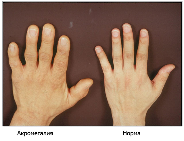 рука человека с акромегалией