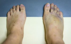 Фиолетовые ступни ног