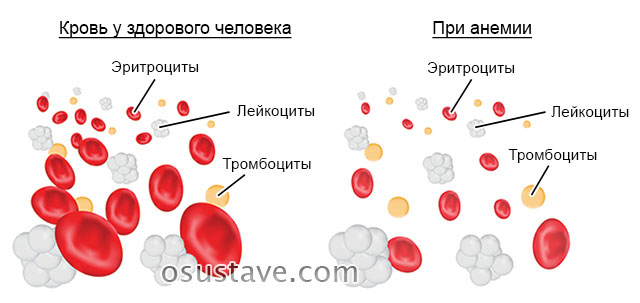 состав крови у здорового человека и при анемии