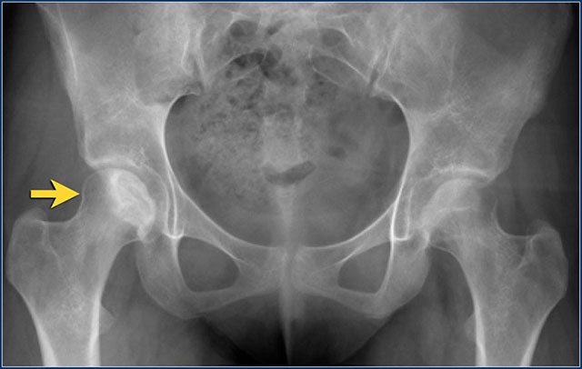 рентгеновский снимок при скоплении жидкости в капсуле тазобедренного сустава