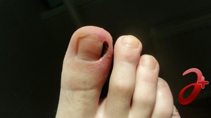 Причина врастания ногтя в палец