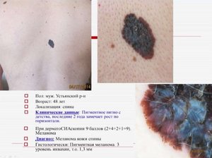 Медицина меланома кожи