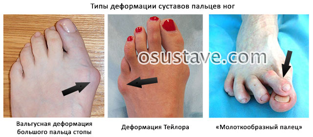 виды деформаций пальцев ног