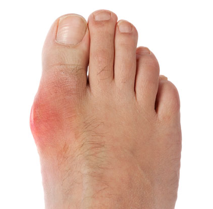подагрический артрит большого пальца стопы