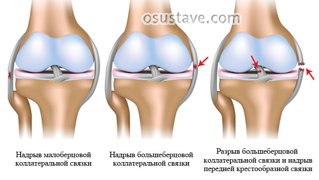 повреждения разных связок коленного сустава