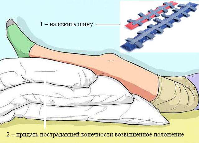 придание пострадавшей ноге возвышенного положения при помощи подушки