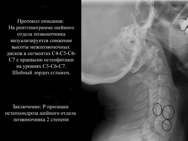 рентгенограмма при остеохондрозе позвоночника