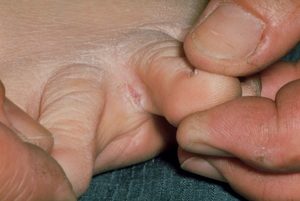 Симптомы и стадии развития микоза между пальцами ног