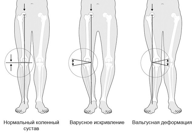нормальное колено, с варусным искривлением и вальгусной деформацией
