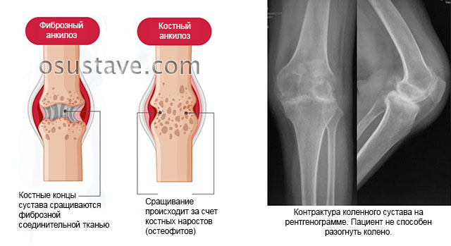 анкилоз и контрактура коленного сустава