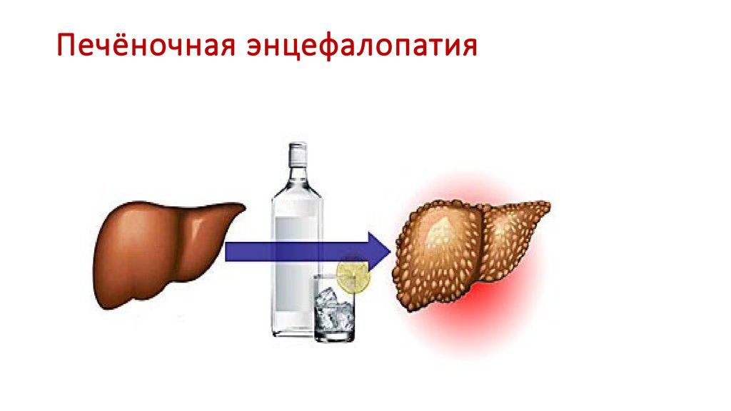 Признаки алкогольного гепатита