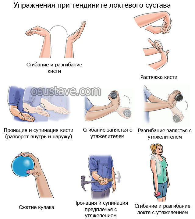 примеры упражнений при тендините локтевого сустава